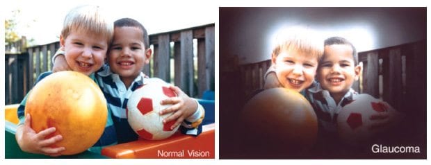 Changes in vision due to glaucoma
