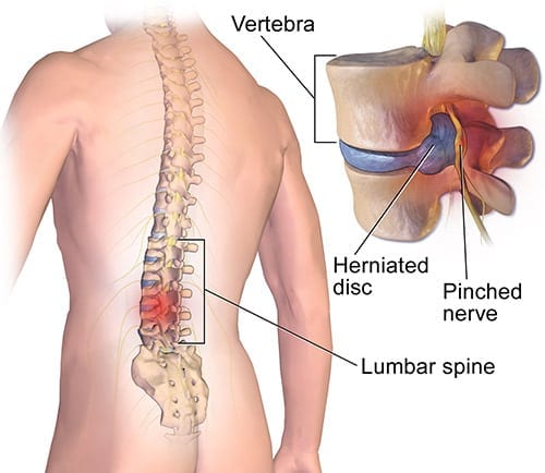 Surgery for low back pain … not so fast! Surgery for low back pain … not so fast!