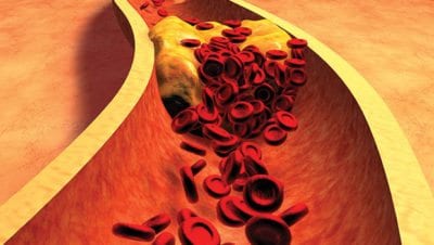 High cholesterol: Common and silent