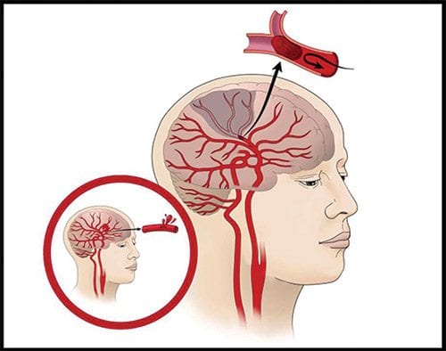 May is National Stroke Awareness Month May is National Stroke Awareness Month
