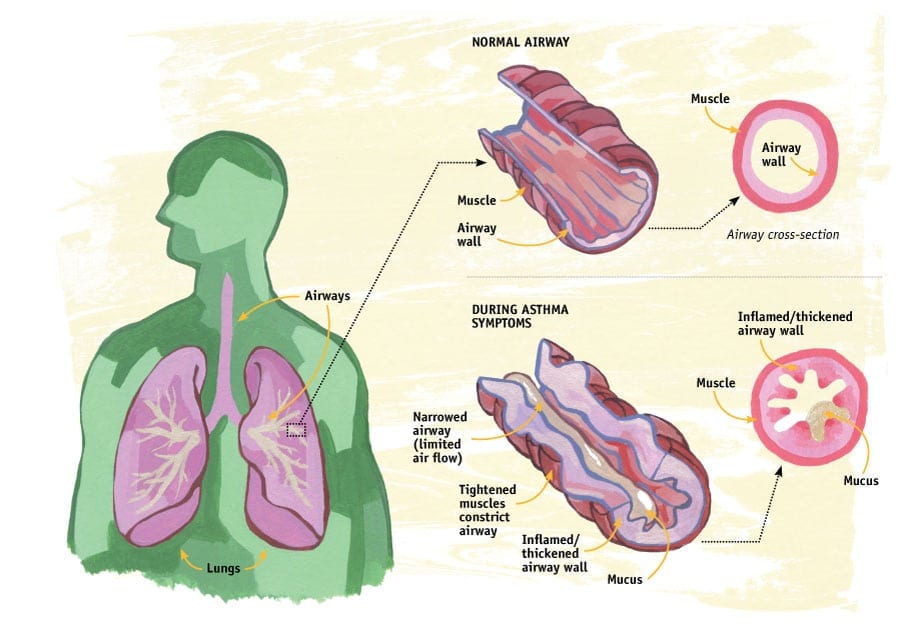 Asthma: A closer look Asthma: A closer look