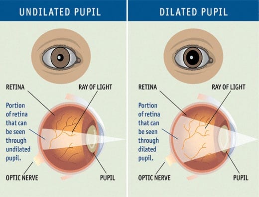 The best attack against glaucoma The best attack against glaucoma