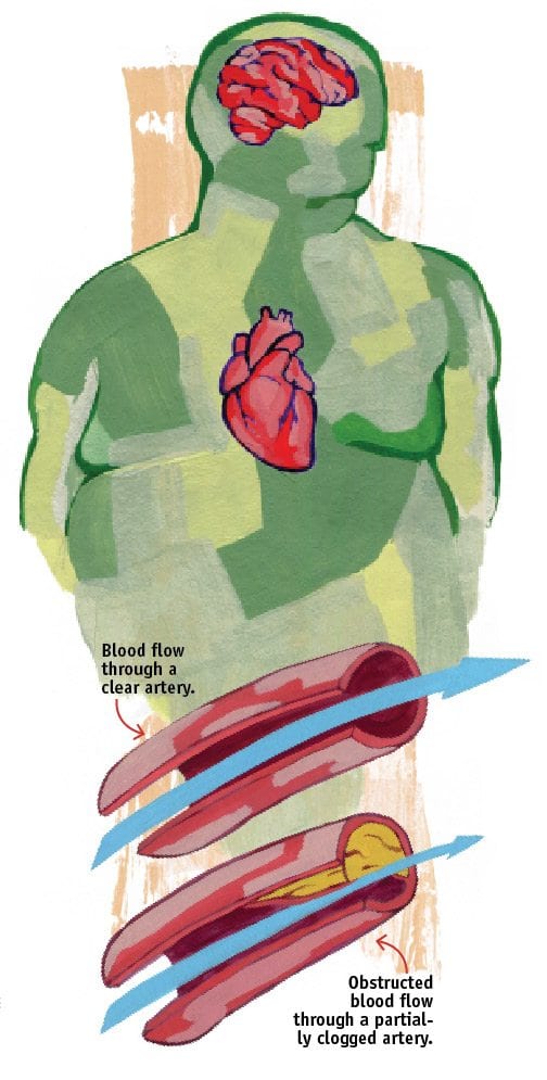 Heart attack and stroke Heart attack and stroke